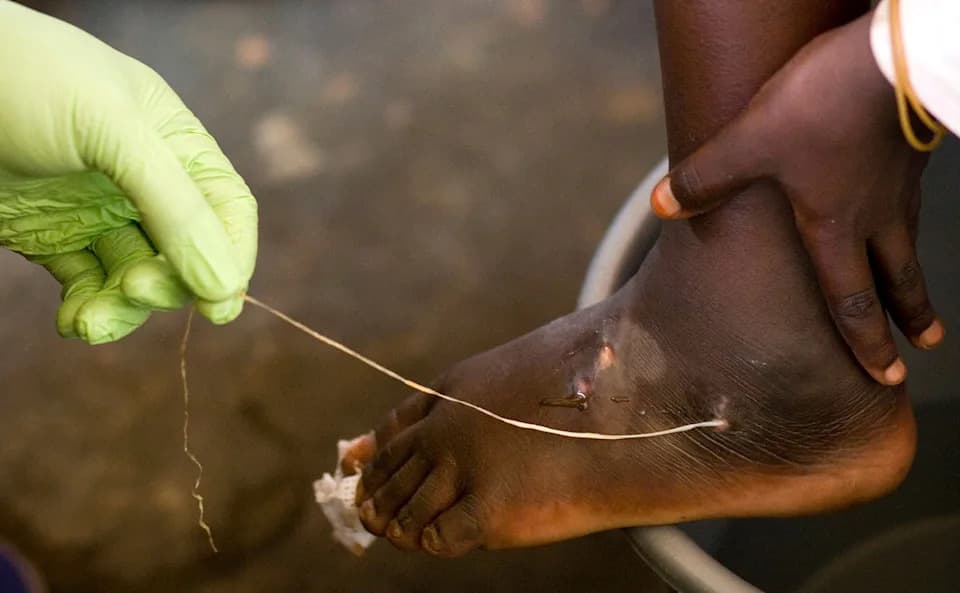 Historic Low: Just 10 Human Guinea Worm Cases Reported in 2025, Carter Center Says