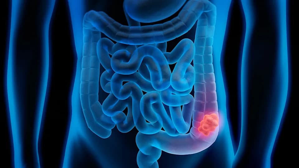 Newly Identified Virus Inside Gut Bacteria Found Twice As Often In Colorectal Cancer Patients