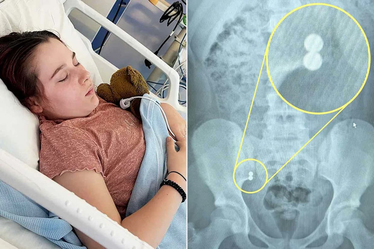 12-Year-Old With Autism Requires Emergency Surgery After Swallowing Magnetic Fidget Beads