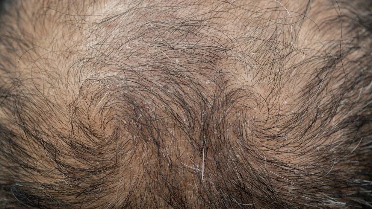 Common Sweetener Stevioside Boosts Minoxidil Delivery With Dissolving Microneedle Patch, Study Finds