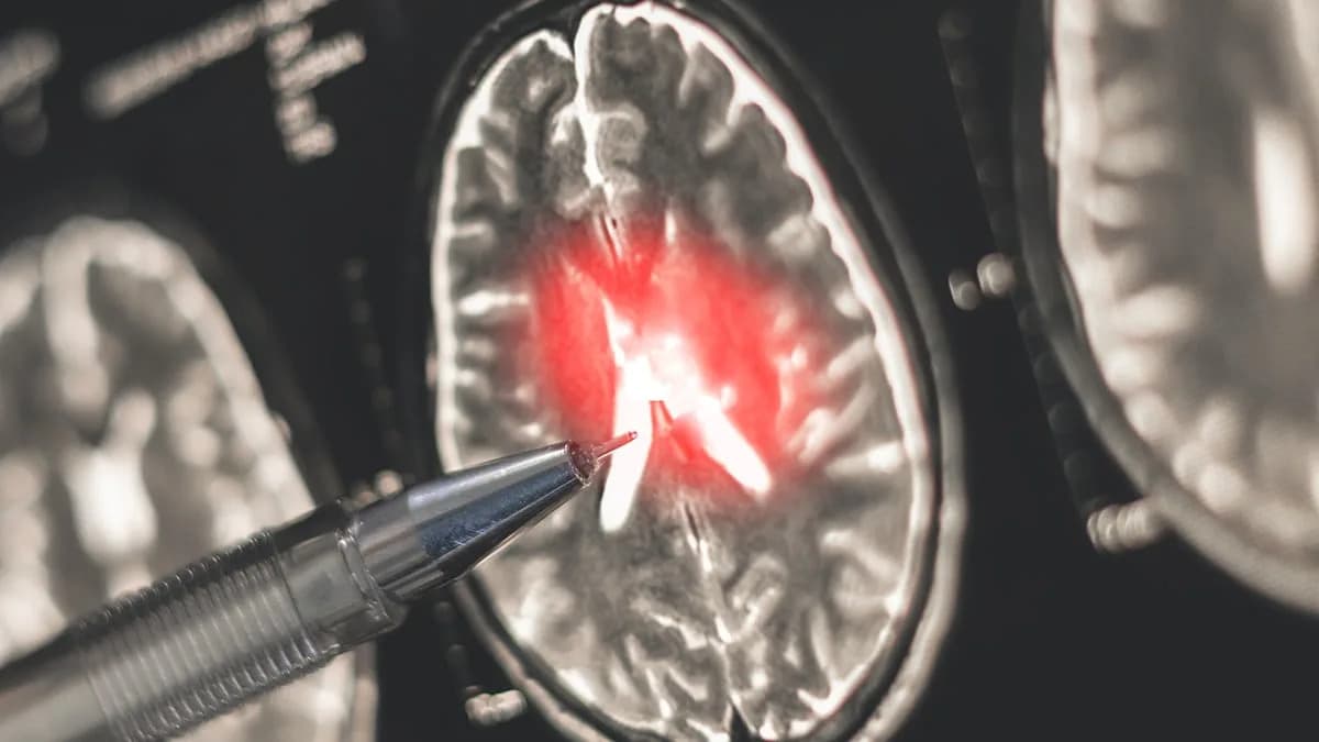 Small Study Finds CSF Protein Differences That May Help Explain Higher MS Risk in Women