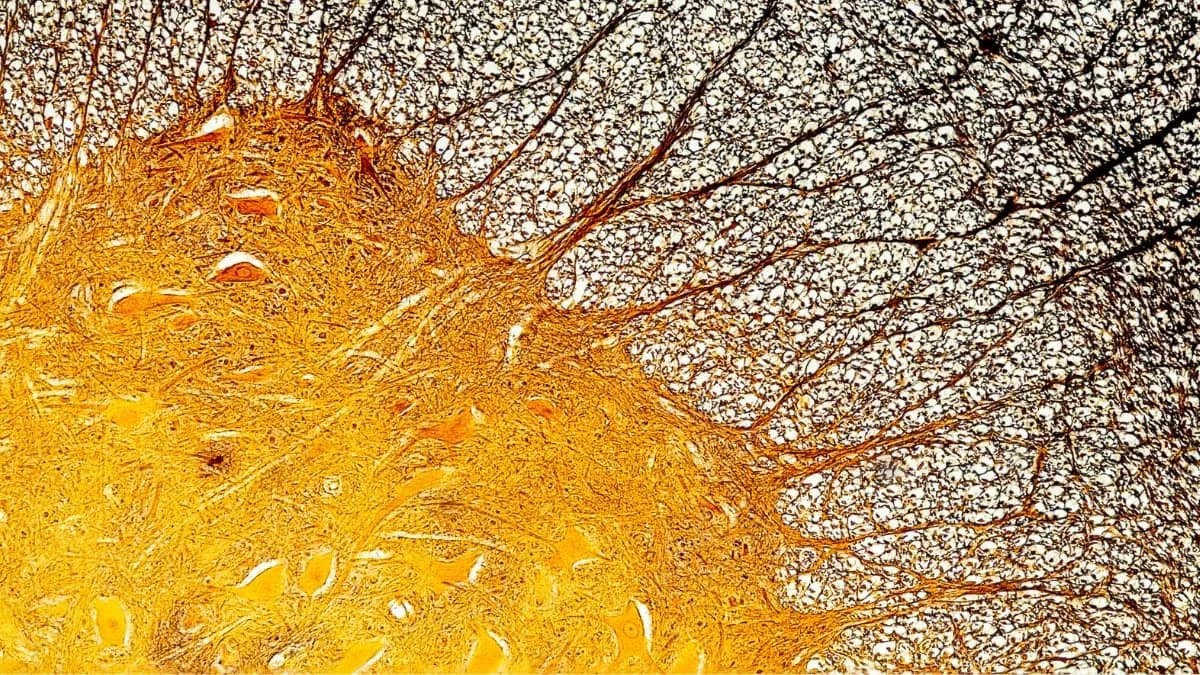 Foamy Microglia May Drive Severe Multiple Sclerosis Progression — Potential Treatment Target and Biomarker Identified