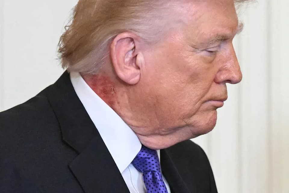 White House Calls Trump ‘In Excellent Health’ After Physical — Report Omits March Neck Rash