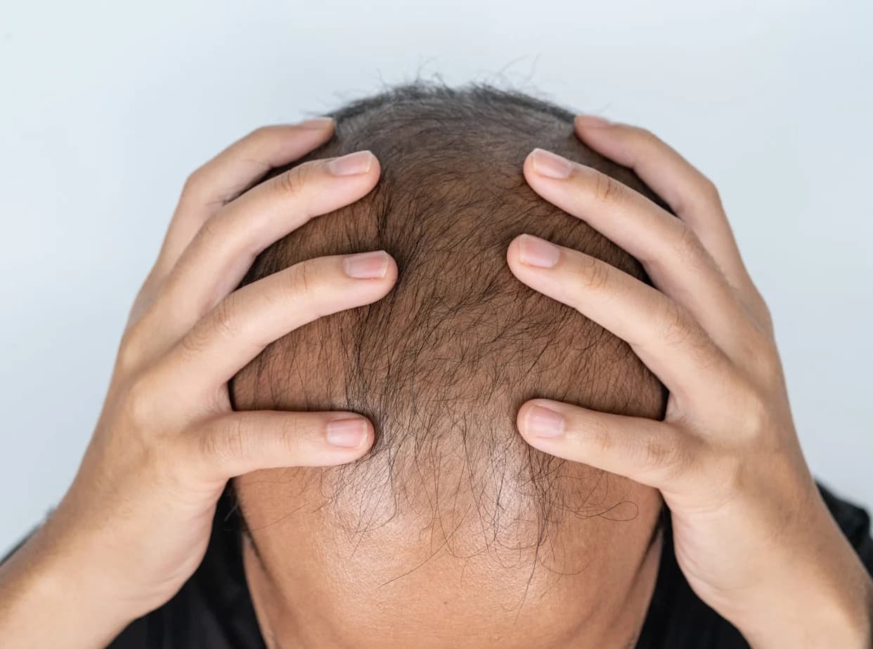 Researchers Are Mining the Body for a Baldness Cure: AI Antibodies, Metabolism Hacks and a Surprising Sugar