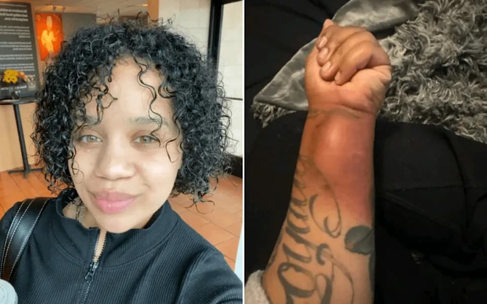 She Lived With 28 Tumours — A Growing Wrist Mass Was Finally Diagnosed As Cancer