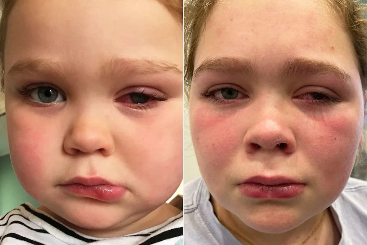 Teen Risks Losing Her Remaining Eye After Childhood Misdiagnosis — Family Makes Eight‑Hour Trip for Specialist Care