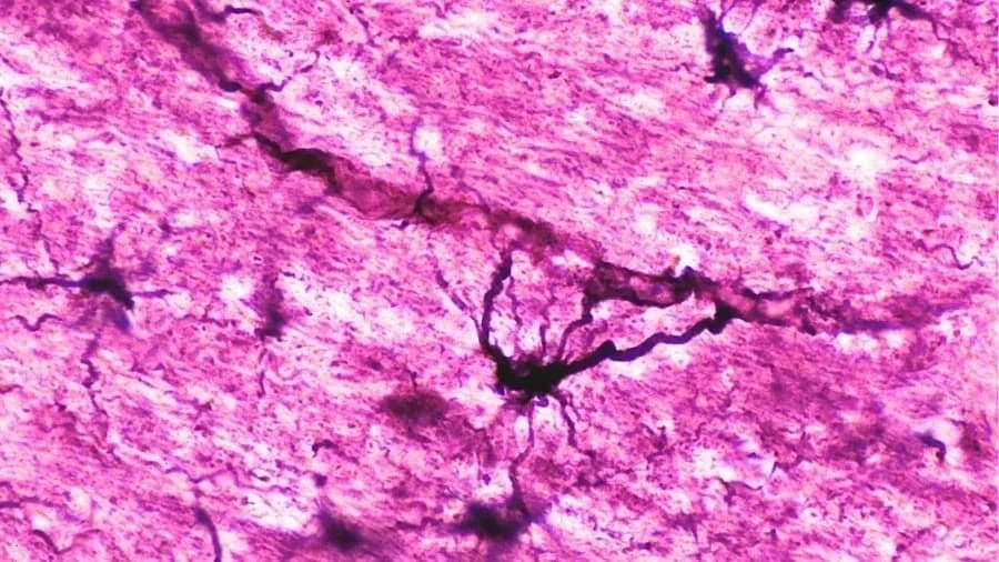 Two Patients With Severe Neuromyelitis Optica Achieve 15+ Years Remission After Immune 'Reset' Transplant