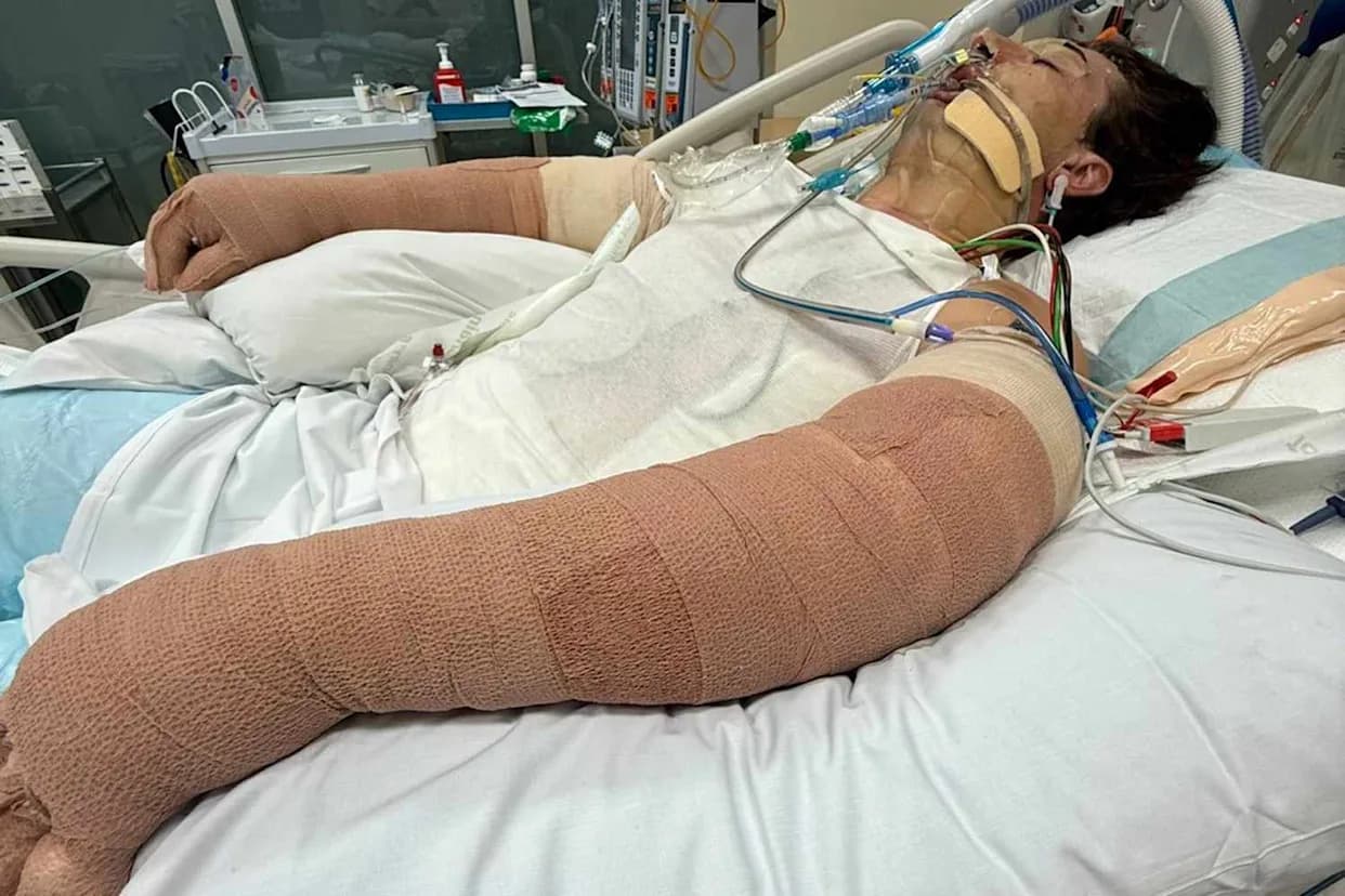 Robot Vacuum Blaze Critically Burns 25-Year-Old in Perth; Family Displaced, Fundraiser Launched