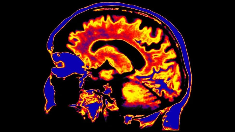 Brain’s 'Waste-Clearing' System Linked to Chronic Fatigue Syndrome — MRI Shows Right‑Hemisphere Glymphatic Dysfunction