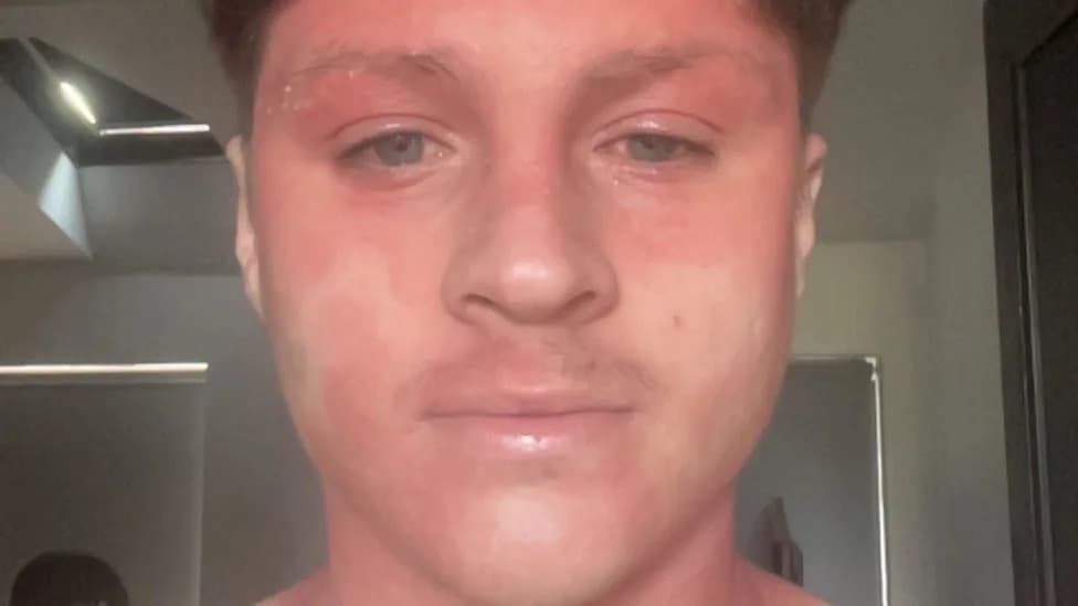 Steroid-Cream Withdrawal Left University Footballer 'Electrocuted' and Bedridden