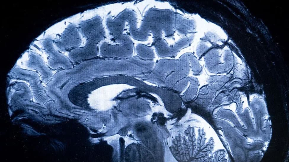 Midlife 'Takeover' in the Hippocampus: Bloodlike Immune Cells Replace Microglia and May Drive Brain Aging