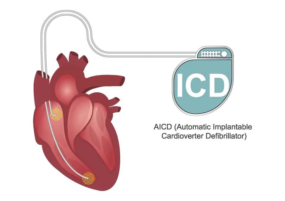 AI Finds New EKG Signature That Flags Patients at Higher Risk Of Sudden Cardiac Death