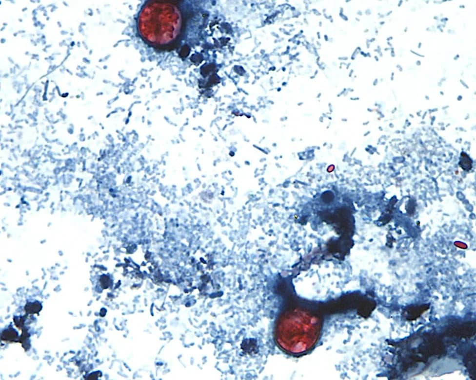 bioMérieux Says U.S. Cyclospora Outbreak May Be Easing After Mid‑July Peak