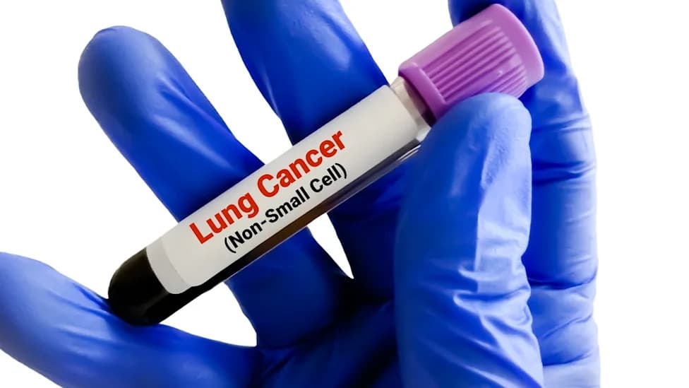 Akeso Wins NMPA Approval for Ivonescimab Plus Chemotherapy as First-Line Treatment for Squamous NSCLC in China