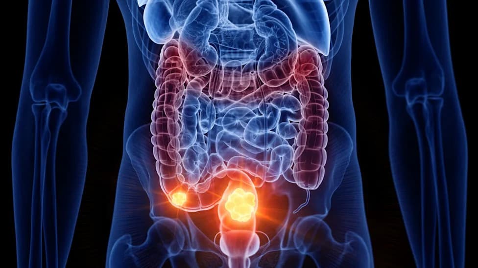 Rising Colorectal Cancer Among Young Adults Is Puzzling Scientists — Here's What We Know
