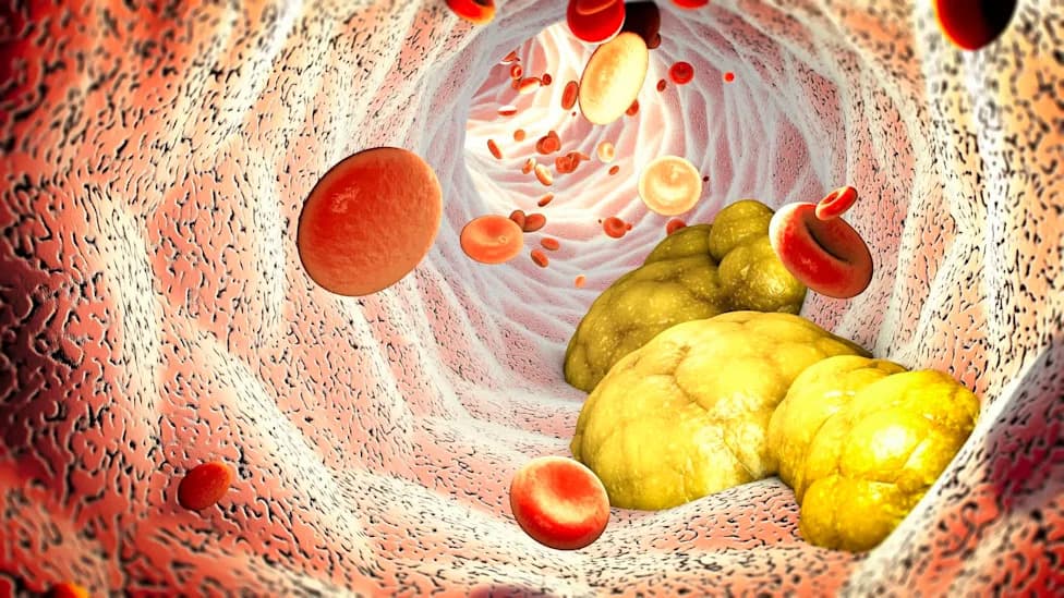 Therapeutic Apheresis May Also Remove Some PFAS And Microplastics, Early Study Finds
