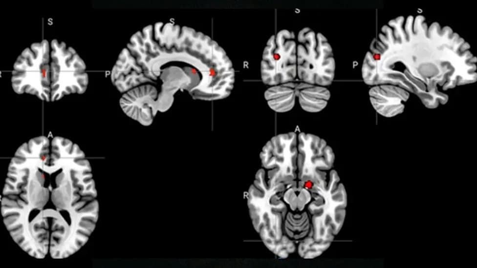Brain Scans Suggest Acupuncture Rewires Emotion and Reward Circuits in Depression