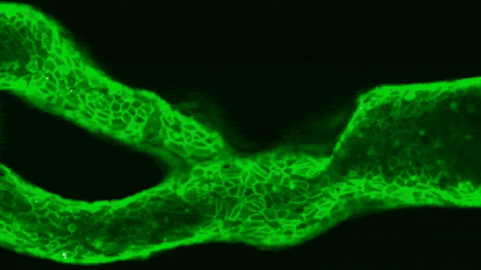 Patient-Specific “Arteries‑on‑a‑Chip” Could Help Predict Individual Stroke Risk