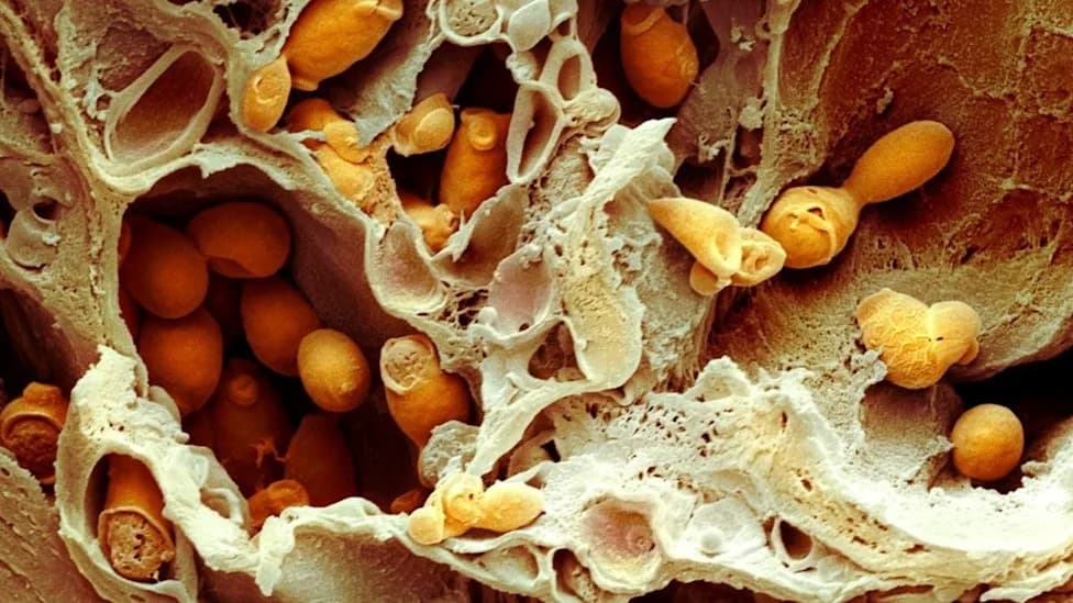 Gladiolin, A Bacterial Antibiotic, Reverts Drug-Resistant Candida to a Less Harmful Form — A Promising Lab Discovery