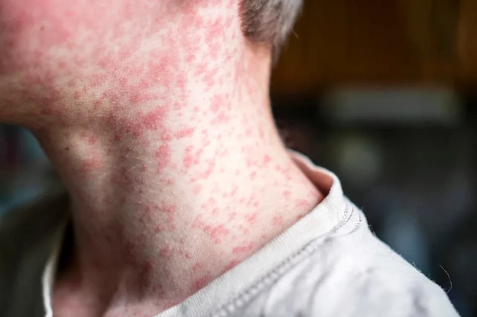 Measles Surge in Pennsylvania: Two Unvaccinated Deaths Reported as Cases Rise Across State and Nation