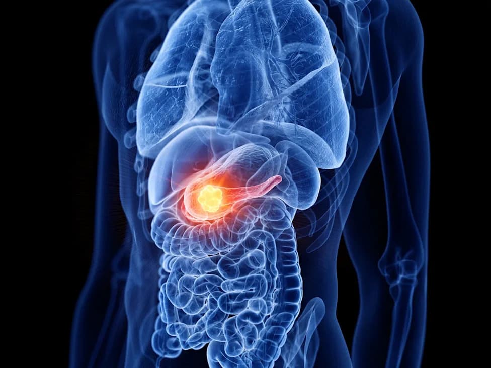 New FDA-Approved Drug Daraxonrasib (Rasonque) Nearly Doubles Survival in Hard-to-Detect Pancreatic Cancer