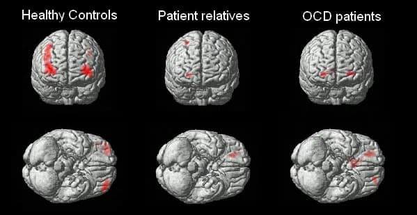 36 Genes Linked to OCD and Tics Reveal New Drug Targets; Blocking EFHD1 May Protect Fatty Livers
