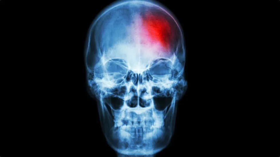 Hidden Immune Activity in Skull Bone Marrow Linked to Chronic Pain, Study Finds