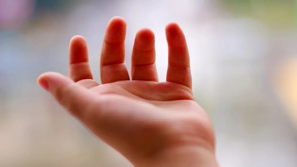 Study Reframes Cerebral Palsy: Often a Feature Of Other Genetic Disorders, Not A Single Disease