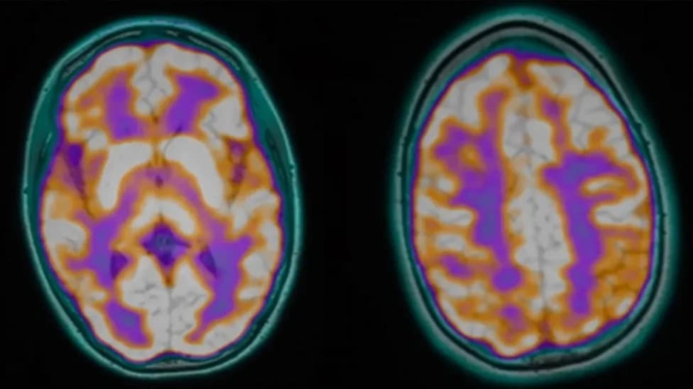 Postmortem Tests Found Babesia Parasites and Bartonella DNA in Six Young Patients — Link to Illnesses Remains Unproven