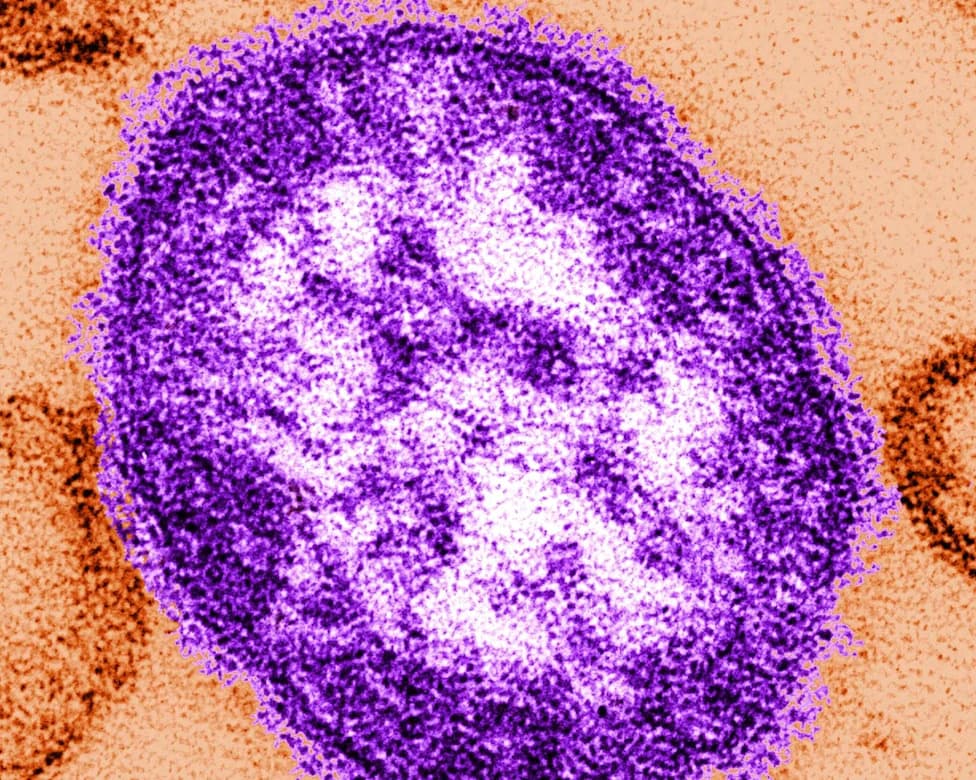Coroner: Six-Week-Old Infant Died Of Measles As Lancaster County Outbreak Widens