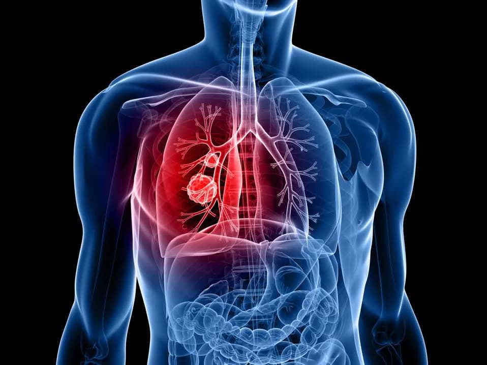 Pancreatic Cancer Drug Daraxonrasib Shows Early Promise in Advanced Lung Cancer Trial