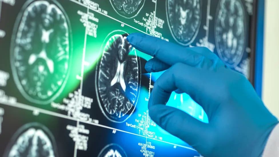 Surrey NHS Trust First In Europe To Join Global Trontinemab Alzheimer’s Prevention Trial