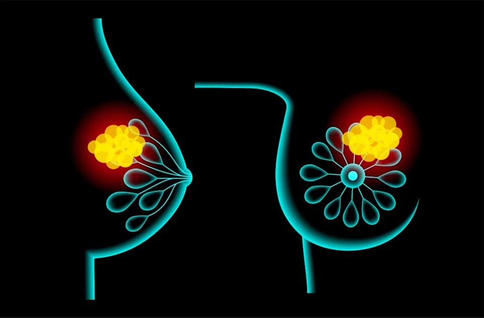 FDA Grants Accelerated Approval to Etcamah for Treatment-Resistant Advanced Breast Cancer