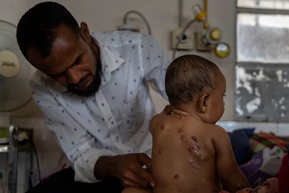 Bangladesh Rushes to Vaccinate 19.7 Million Children as Measles Outbreak, Dengue Overwhelm Hospitals