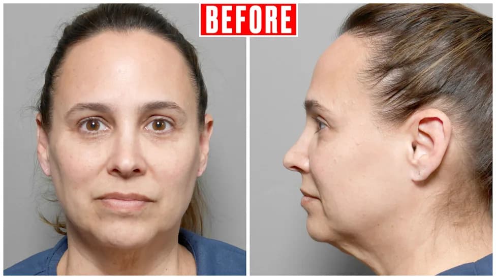 The Ozempic Boom Is Fueling a Surge in Lifts — The Defining Plastic Surgery Trend of 2025