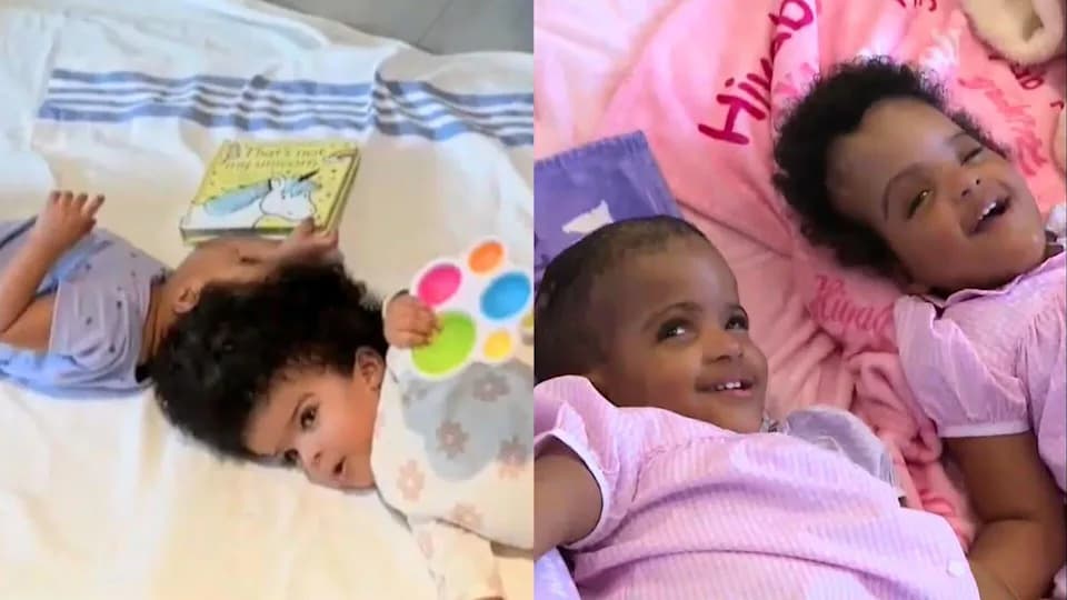 Two-Year-Old Craniopagus Twins Separated After 25-Hour Operation in St. Louis
