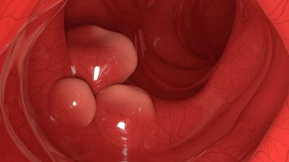 Engineered Probiotic Produces Chemotherapy Inside Tumors and Eradicates 43% of Colorectal Tumors in Mice