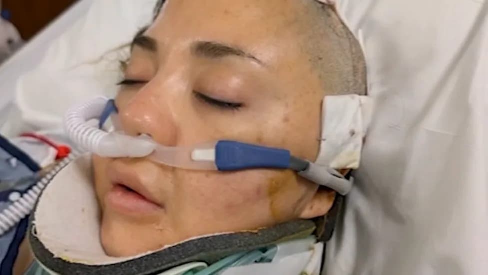More Than 100 Riders Allege Brain Injuries From Six Flags’ X2 Coaster; Multiple Lawsuits Underway