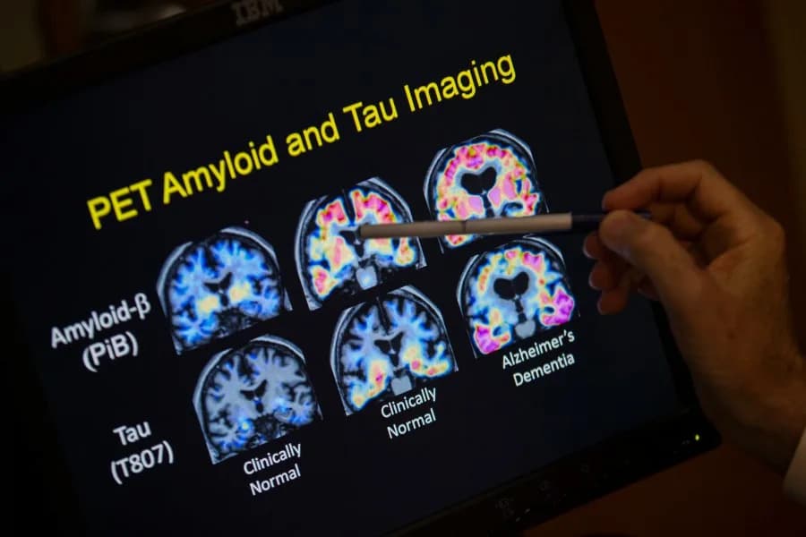 Human Peptide Catestatin (CST) Shows Promise in Mouse Models of Alzheimer’s