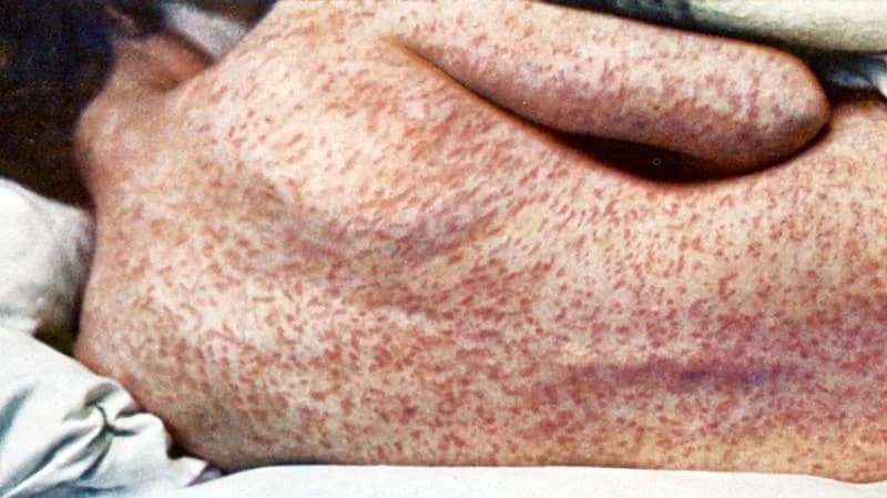 Pennsylvania Has the Worst U.S. Measles Outbreak in 35 Years — Cases Still Rising