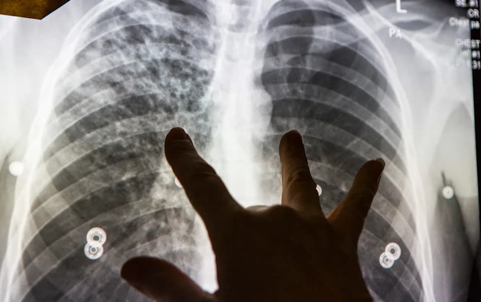 Pooled TB Testing Could Halve Diagnostic Costs and Find Millions Missed, Large Trial Shows