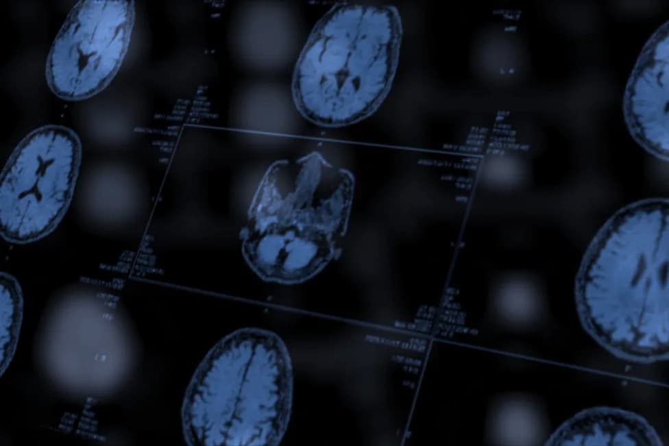 MRI May Detect Alzheimer’s-Related Brain Changes Up to 7 Years Before PET, Longitudinal Study Finds