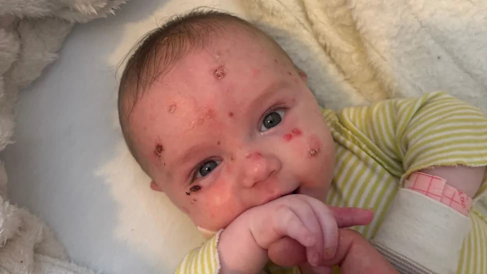 They Said My Baby's Skin Was 'Like Glass' — Family Urges More Research into 'Butterfly Skin' (JEB)