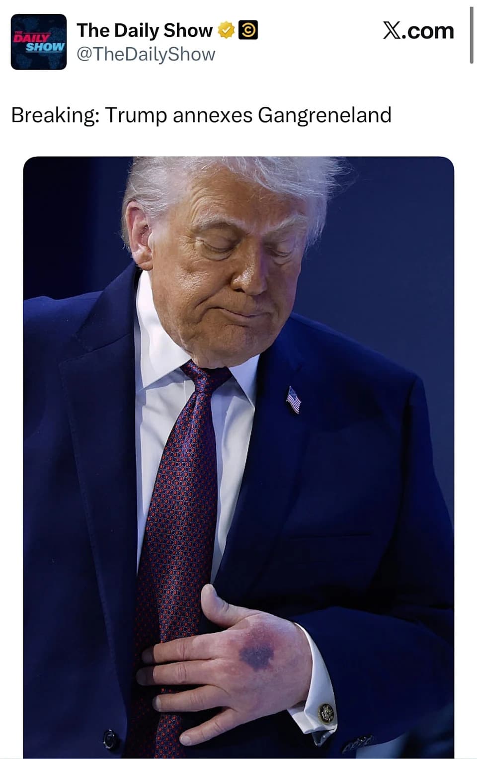 Daily Show Jokes About Trump’s Davos Hand Bruise; White House Points To Table Knock and Aspirin