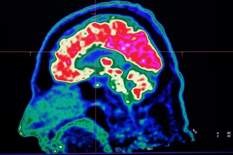 Final Report Finds No Environmental Link In New Brunswick 'Mystery' Brain Illness
