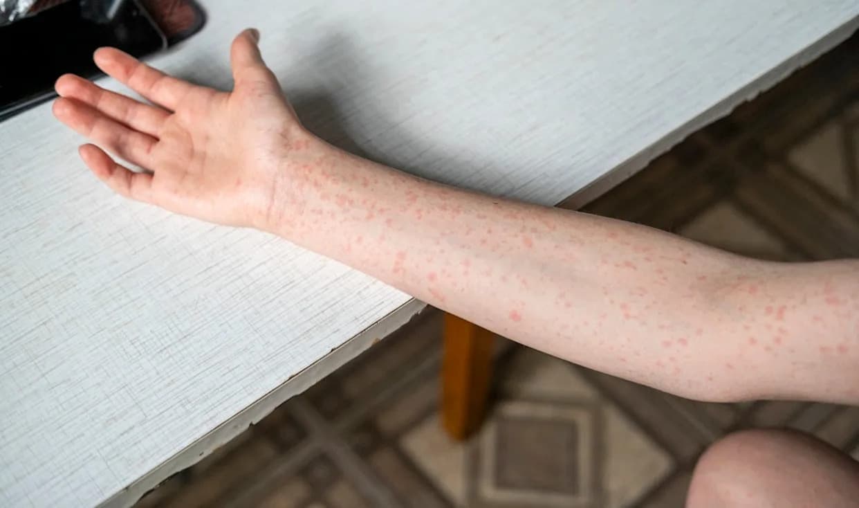 Measles Cluster at Ave Maria University: 40+ Cases Mark Largest Recent U.S. College Outbreak