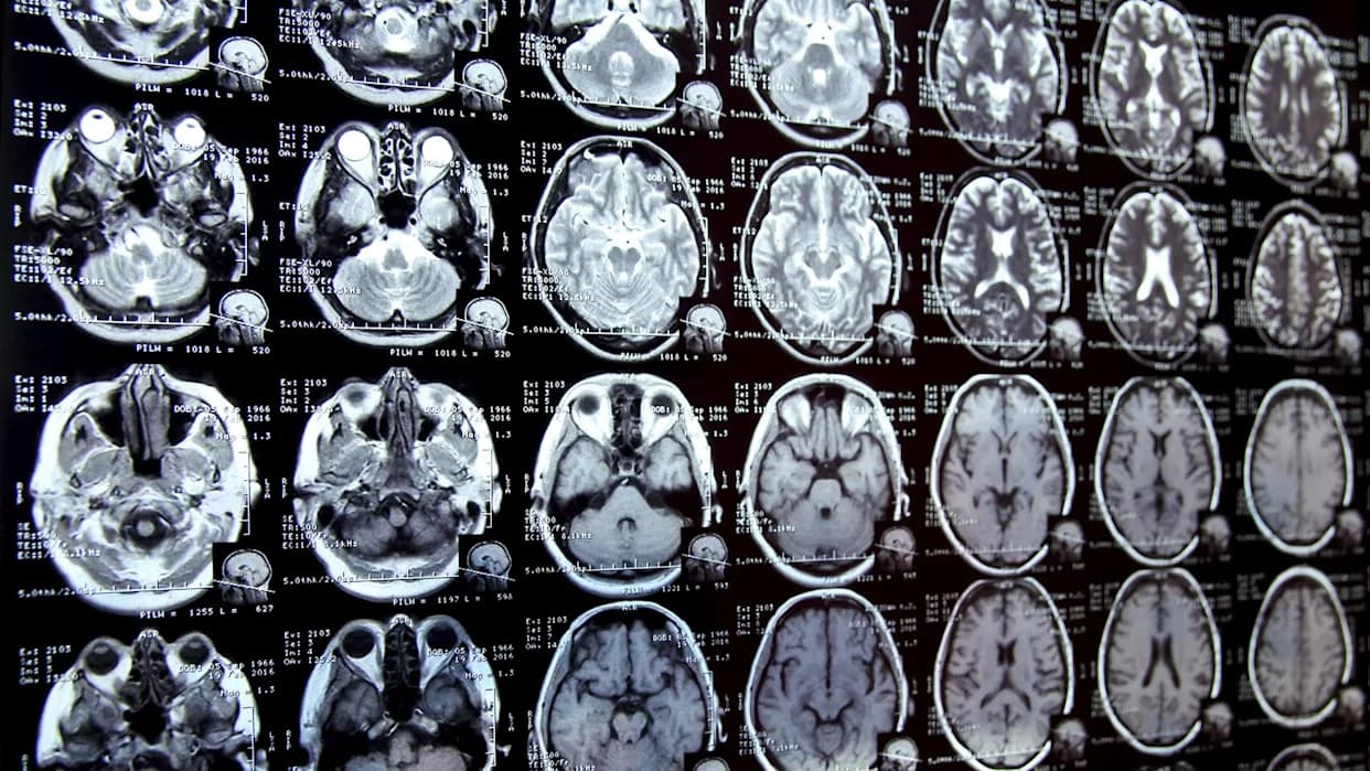 Scientists Warn Microplastics Are Showing Up In Human Brains — Levels Rose Nearly 50% in Eight Years