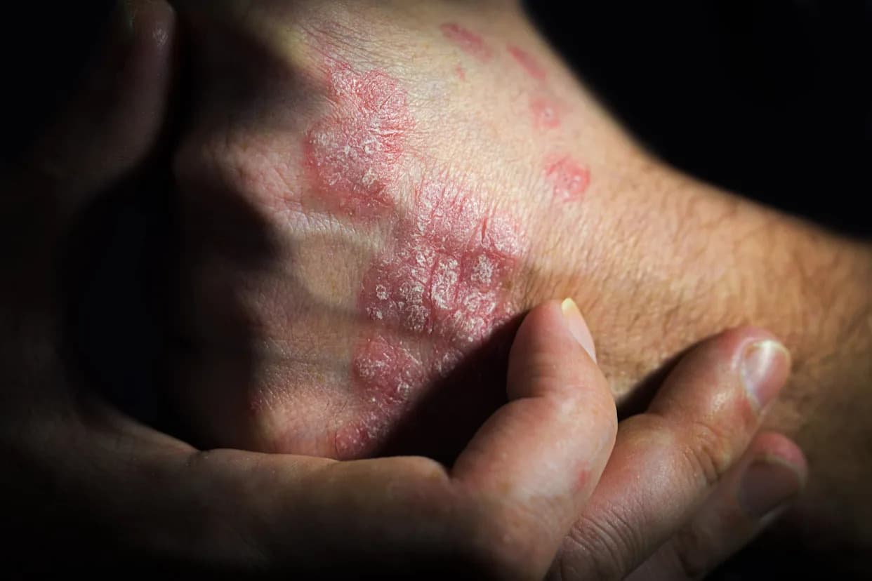 Why Psoriasis Keeps Coming Back In The Same Spots — Your Skin Remembers