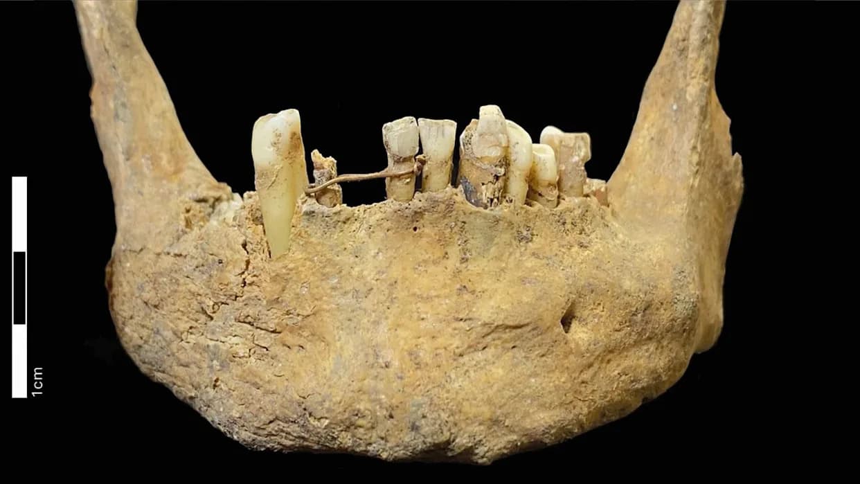 500-Year-Old Gold Dental Bridge Unearthed in Aberdeen — Scotland's Earliest Known Example May Have Held a False Tooth
