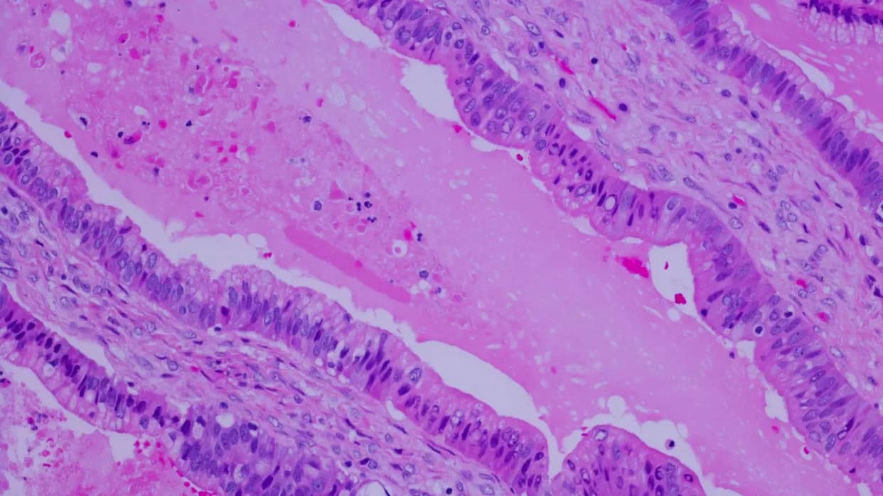 ‘Unprecedented’ Phase 3 Data: Daraxonrasib Nearly Doubles Survival in Advanced Pancreatic Cancer